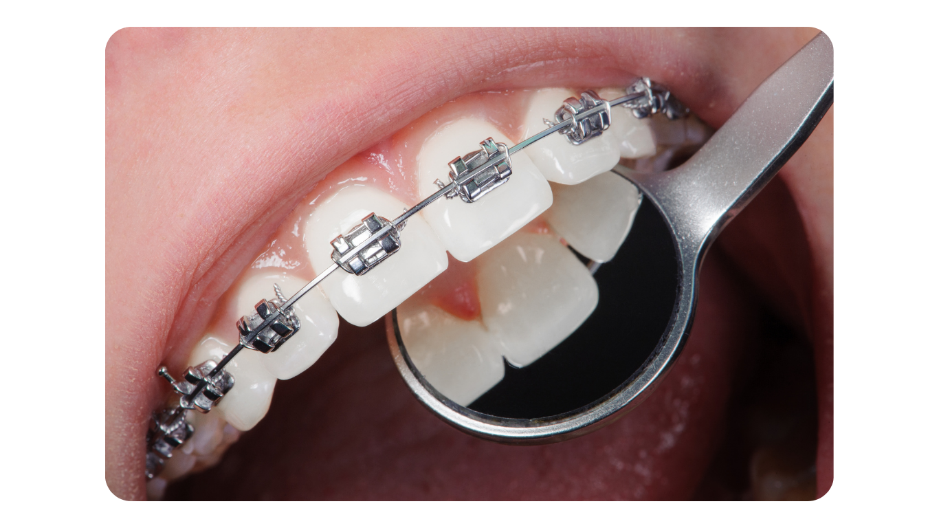 Aparelho Ortodôntico