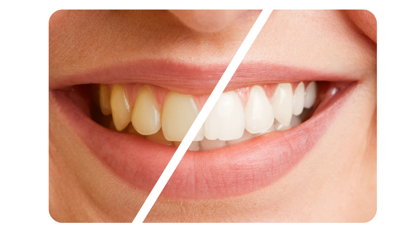 Clareamento Dentário
