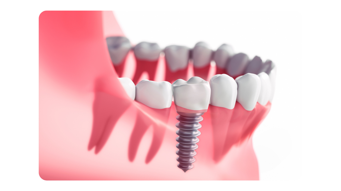 Implante Dentário